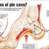 pie cavo